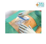 خرید پانسمان جراحی سوربکت (SORBACT SURGICAL DRESSING)