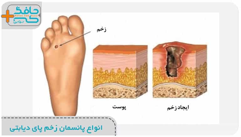 انواع پانسمان زخم پای دیابتی