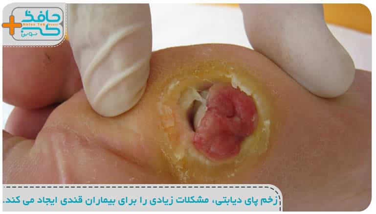 زخم پای دیابتی، مشکلات زیادی را برای بیماران قندی ایجاد می کند
