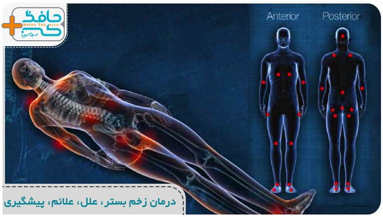 درمان زخم بستر،علل، علائم، پیشگیری