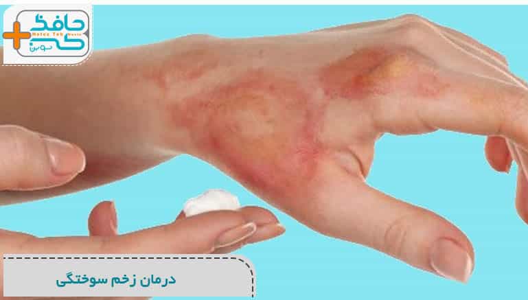 درمان زخم سوختگی