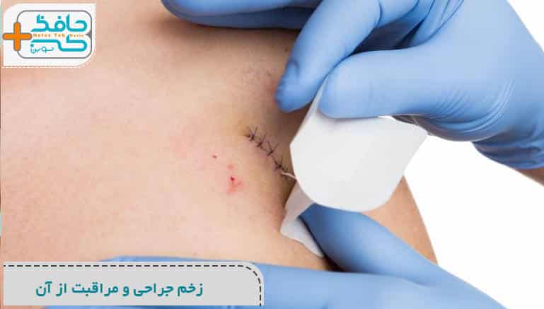 زخم جراحی و مراقبت از آن