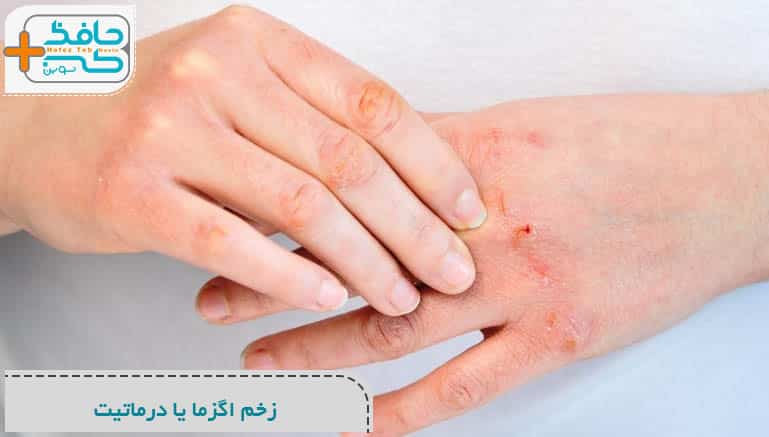زخم اگزما یا درماتیت چیست؟ معرفی و درمان
