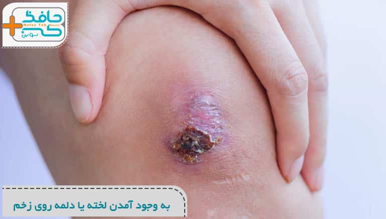 ورق سیلیکونی رفع اسکار چیست؟