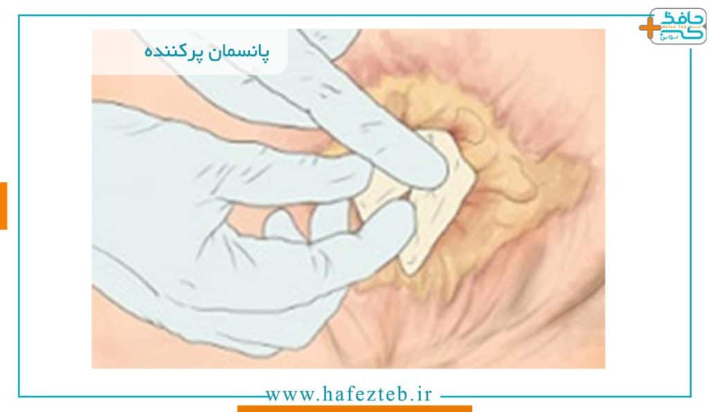 خرید و قیمت پانسمان و پماد پرکننده زخم