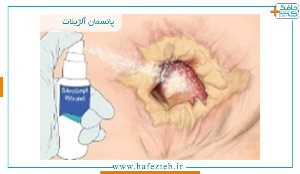 نحوه عملکرد پانسمان آلژینات