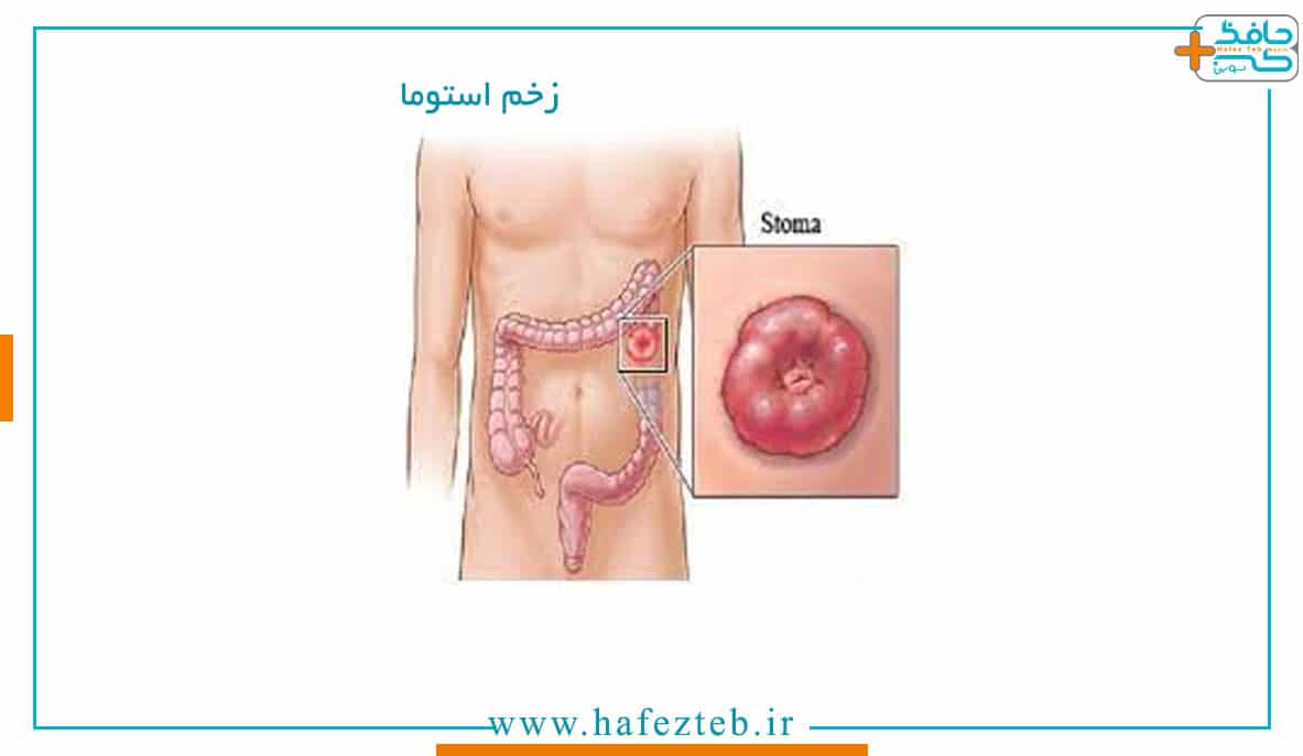 زخم استوما چیست-اطلاعاتی درباره زخم استوما