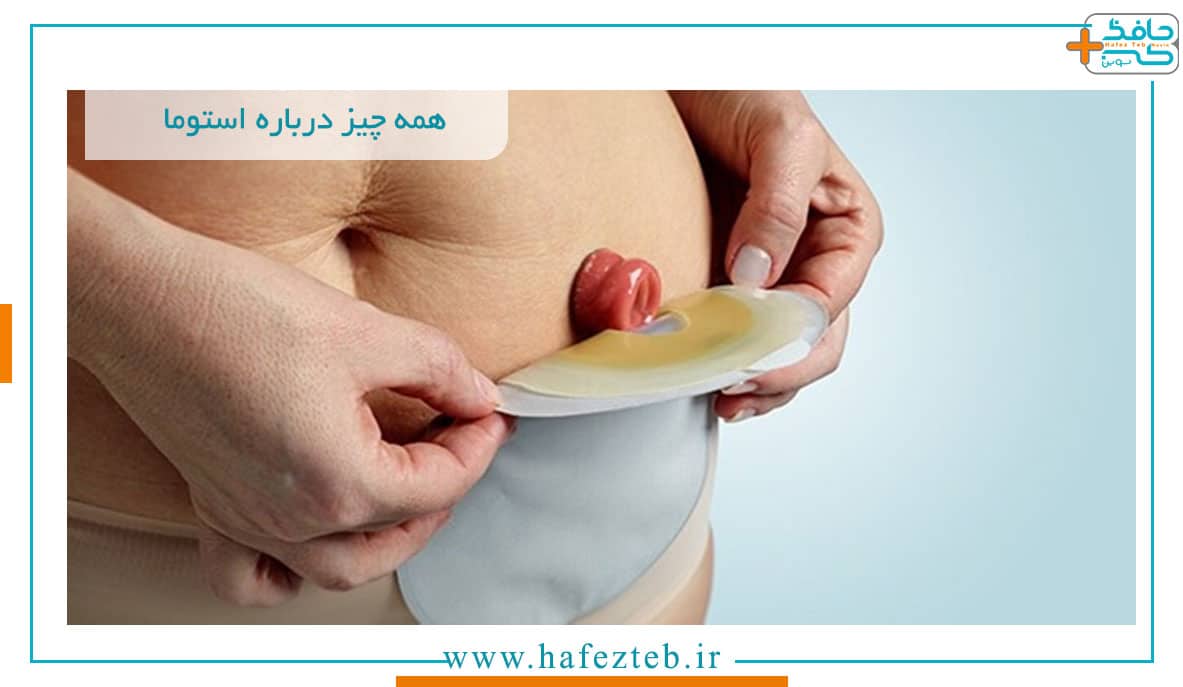 همه چیز درباره عمل جراحی استومی