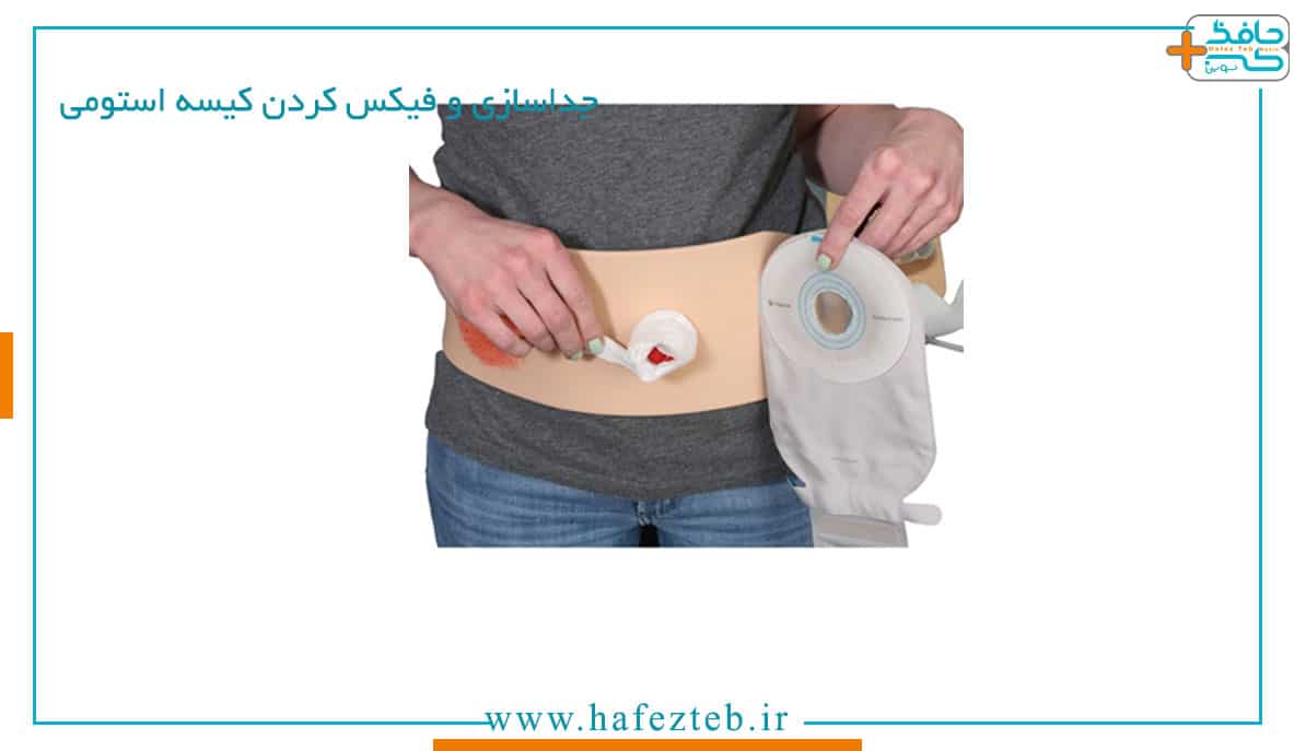 جداسازی و فیکس کردن کیسه استوما یا استومی