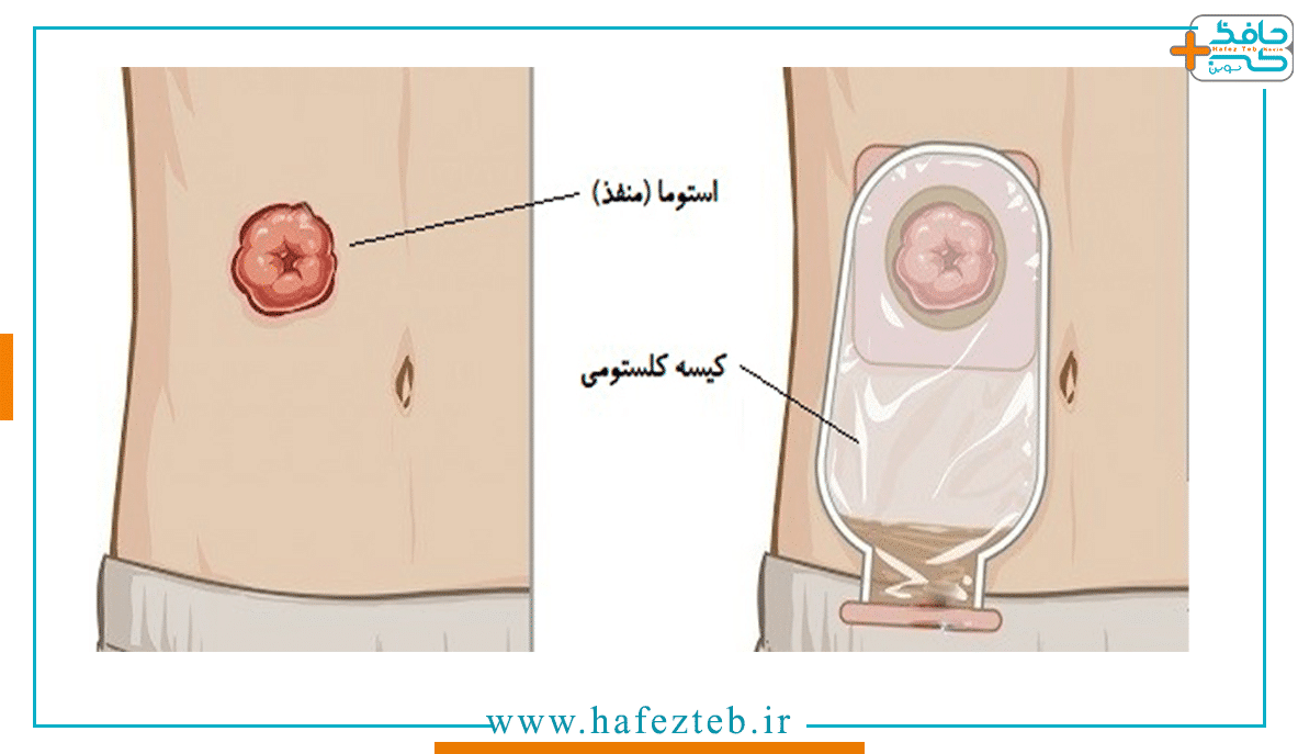 فیکس کردن کیسه استوما