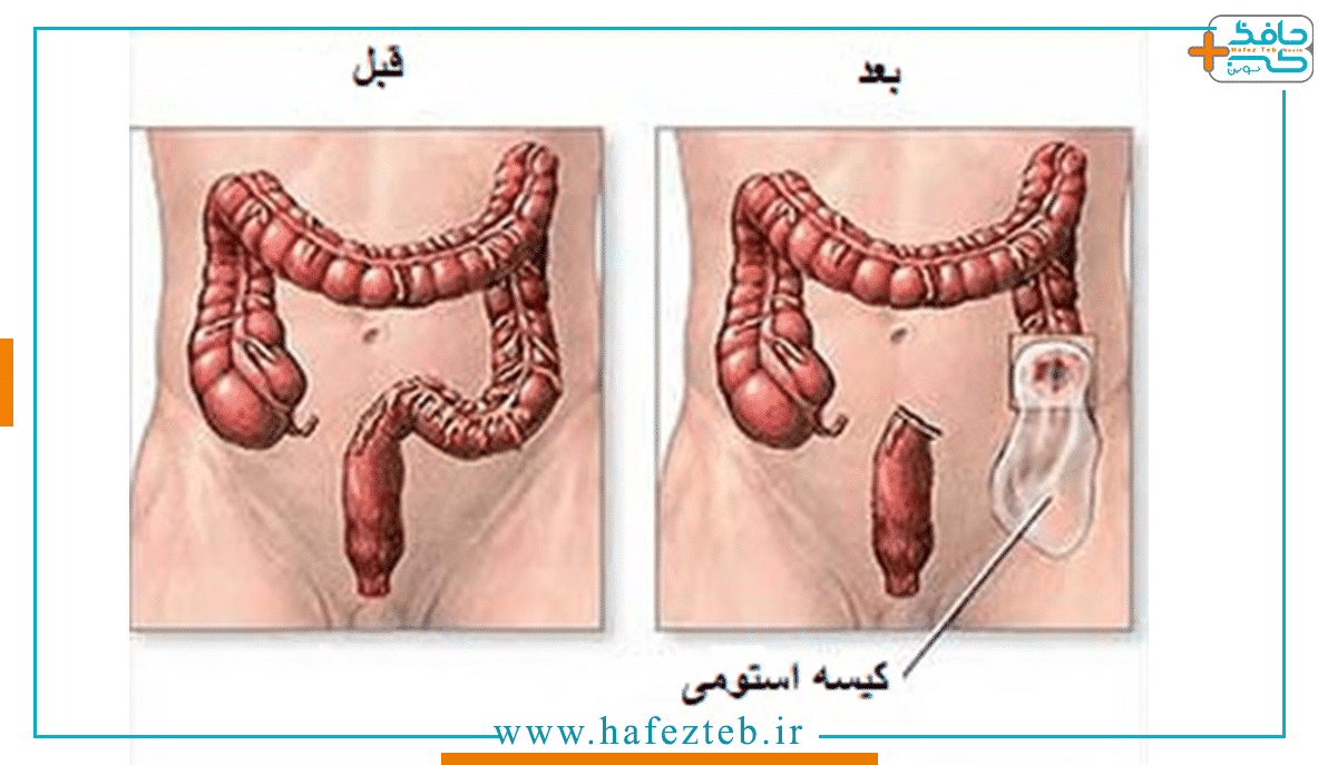 فیکس کردن کیسه استومی