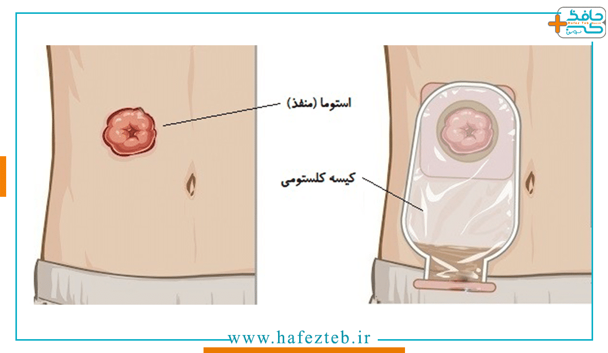 رژیم غذایی کلستومی