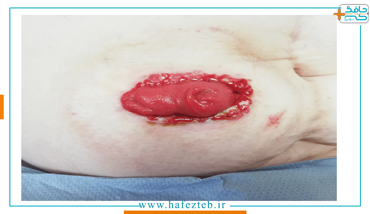 عفونت اطراف زخم استوما؛ در چه صورت باید برای زخم استومی به پزشک مراجعه کنیم؟