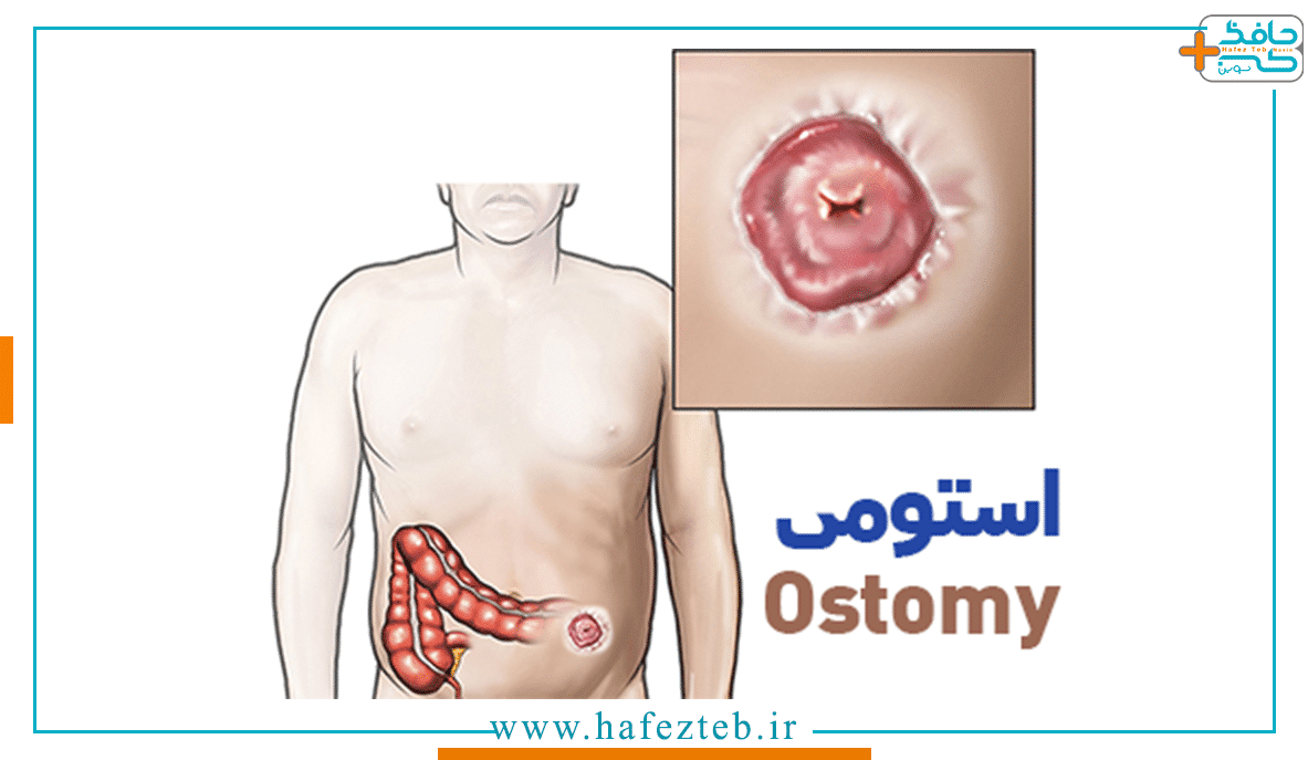 مشکلات پوستی ناشی از استوما