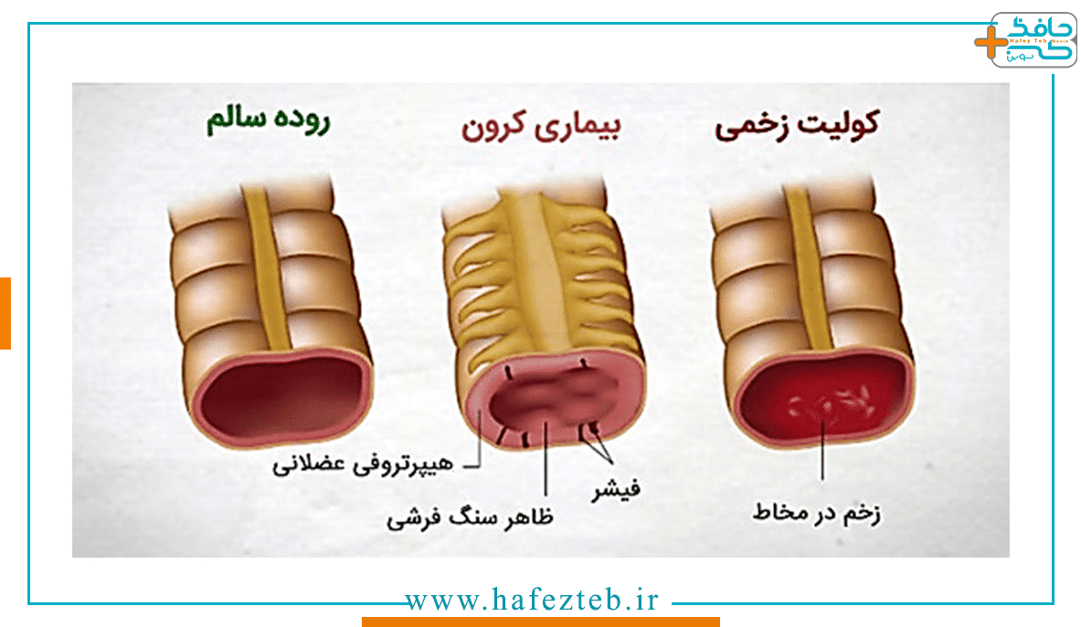 آيا استومي عوارض دارد ؟