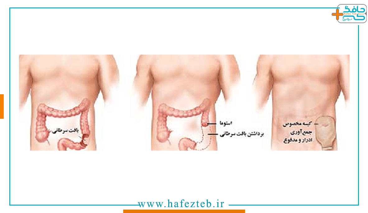 مراحل استومی کدامند؟