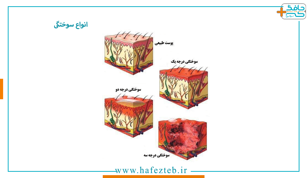 آشنایی با سوختگی درجه یک و درمان خانگی آن