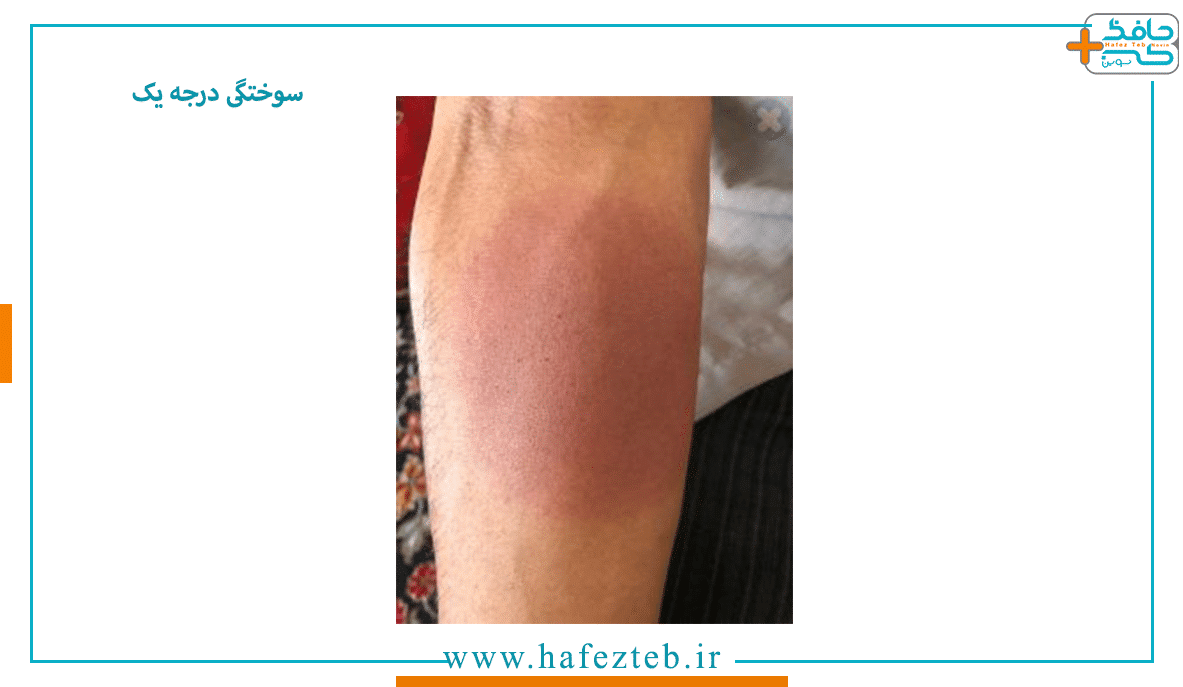 درمان سوختگی درجه یک و دو با روغن