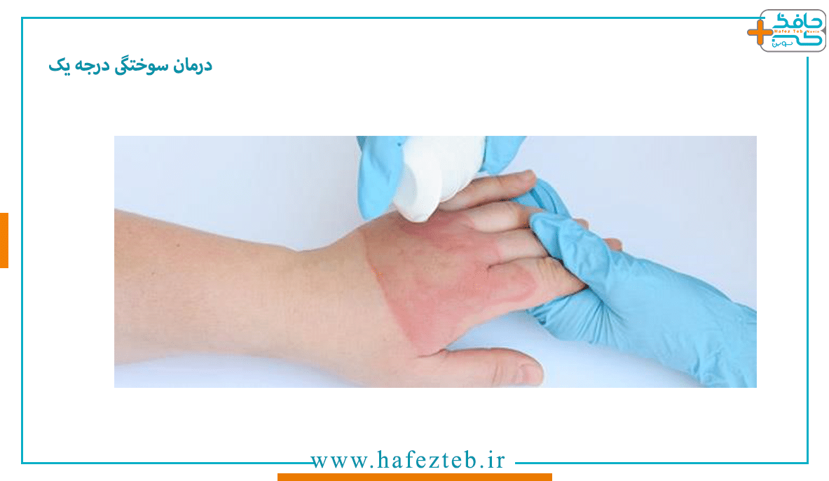 پیشگیری از سوختگی درجه یک