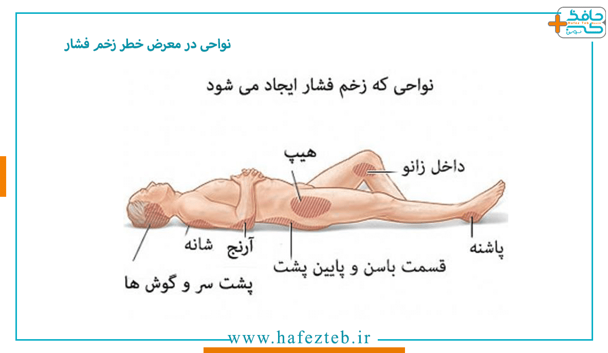 نواحی در معرض خطر زخم فشار