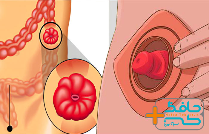 استومی چیست و چه محدودیت هایی برای بیمار ایجاد میکند؟