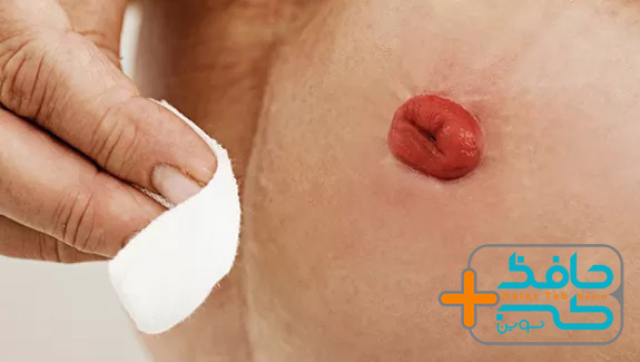 زخم استوما چیست-اطلاعاتی درباره زخم استوما