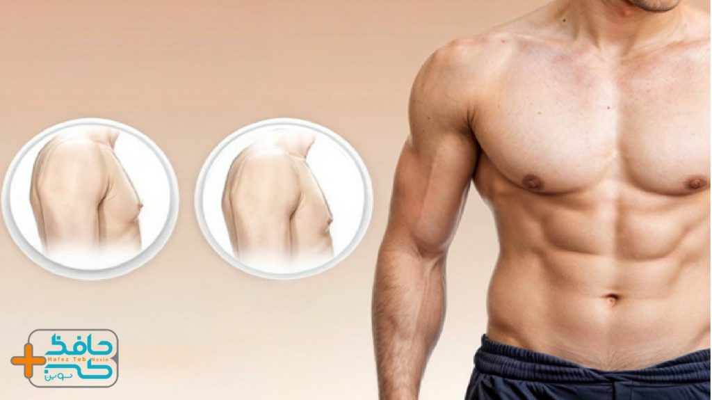 Is it better to treat gynecomastia with medication or surgery 3 ژنیکوماستی با دارو بهتر است یا جراحی؟