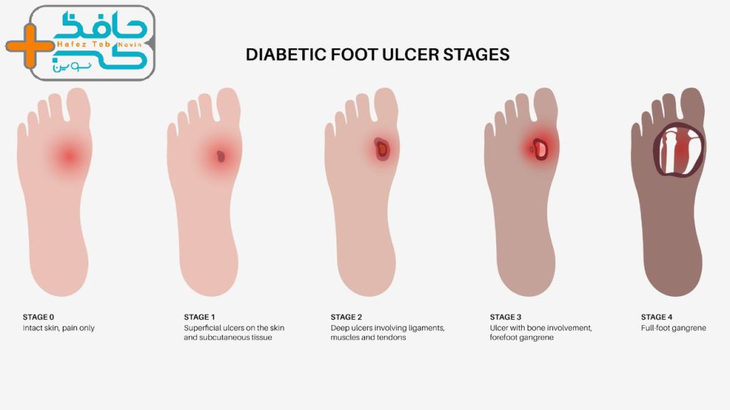 The effect of honey on the treatment of diabetic ulcers 3 تاثیر عسل بر درمان زخم دیابتی