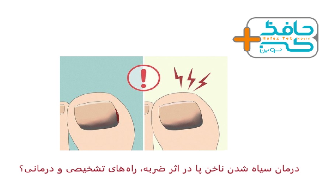 درمان سیاه شدن ناخن پا در اثر ضربه، راه های تشخیصی و درمانی؟
