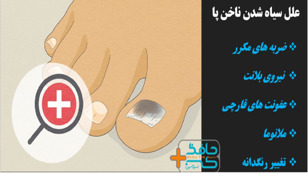 آشنایی با علل سیاهی ناخن انگشت پا