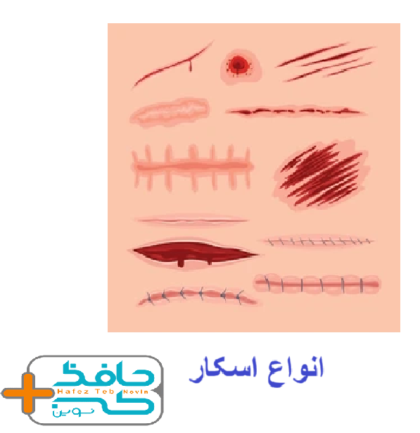 اسکار به دلایل مختلفی مانند عفونت، زخم، جراحی و یا سوختگی ایجاد می شود