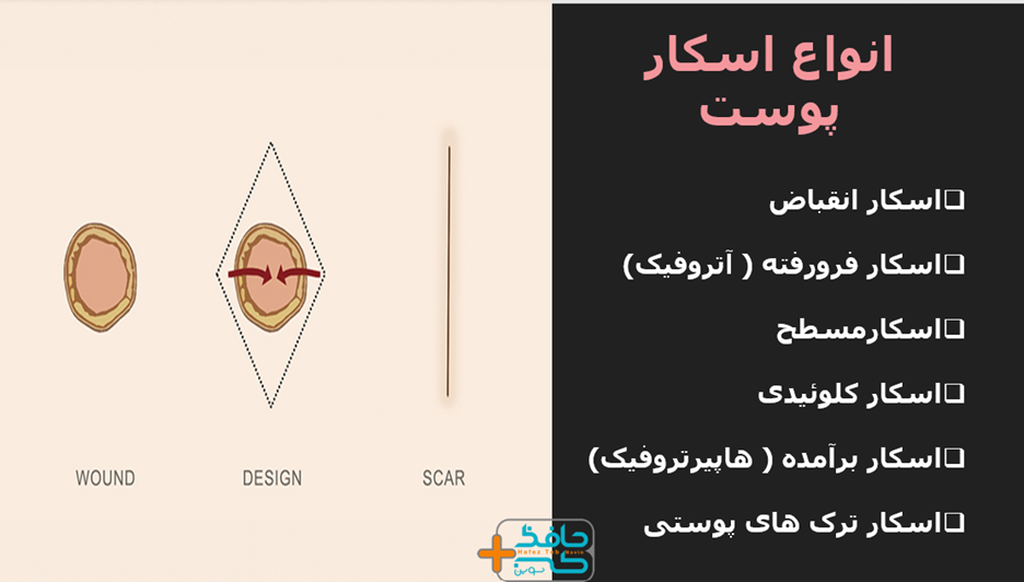 شناخت اسکارهای پوستی به شما کمک می کند راه های درمانی مناسب را برای بهبود جای زخم خود برگزینید