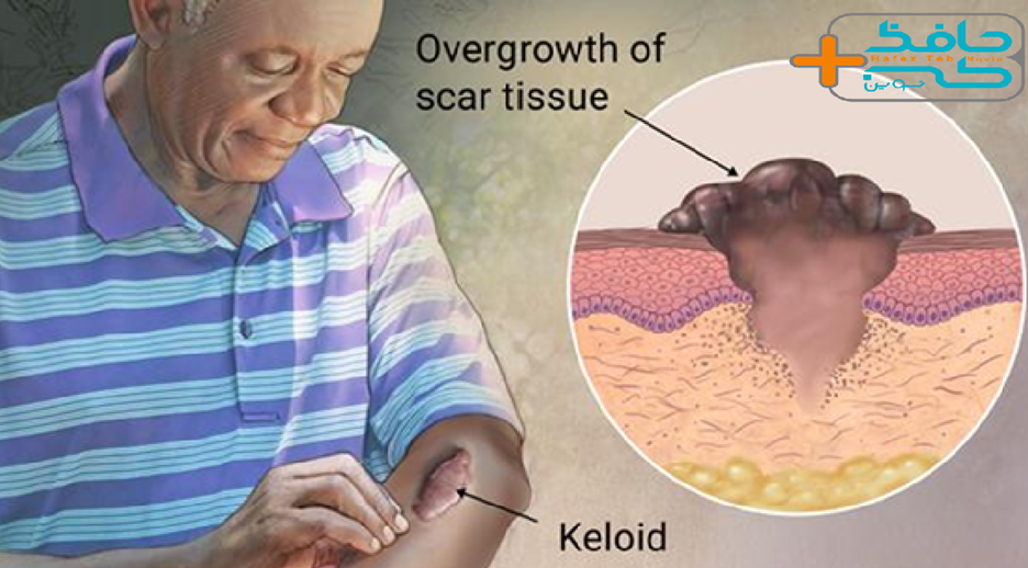 What is a surgical scar How long does a surgical scar last and how to prevent and treat it5 اسکار جراحی چیست؟