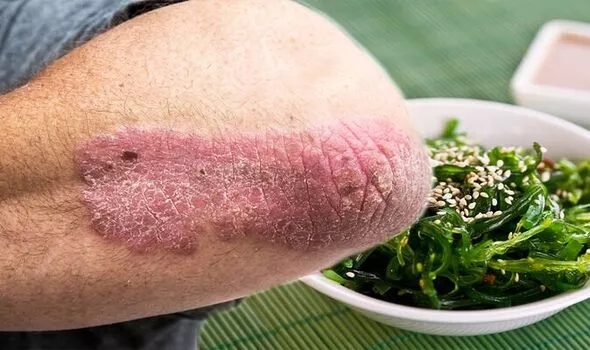 What to eat to treat shingles 3 1 درمان زونا