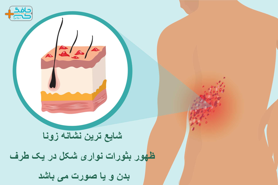 علائم زونا می تواند به صورت نواری و در یک طرف ظاهر شود