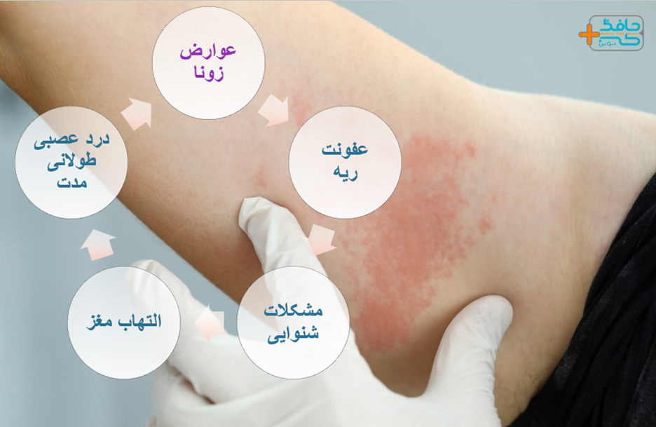 آیا زونا برای جنین خطرناک است؟