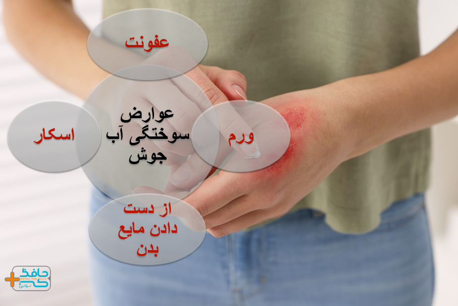 سوختگی با آب جوش می تواند منجر به ورم و اسکار شود