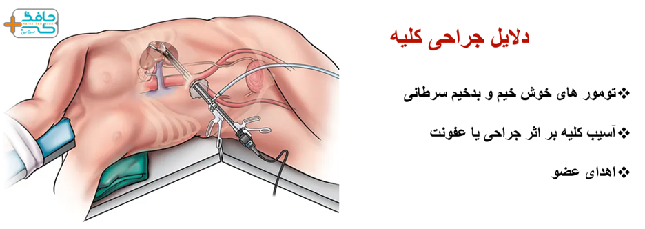 تومورهای خوش خیم و بدخیم سرطانی، عفونت و یا اهدا کلیه می تواند از دلایل جراحی برداشتن کلیه باشند