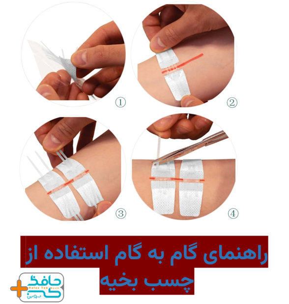 قبل از استفاده از چسب بخیه محل زخم را با آب و صابون بشوئید و یا ضدعفونی کنید