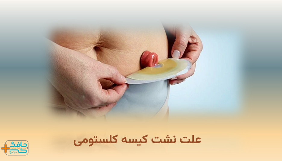 علت نشت کیسه کلستومی