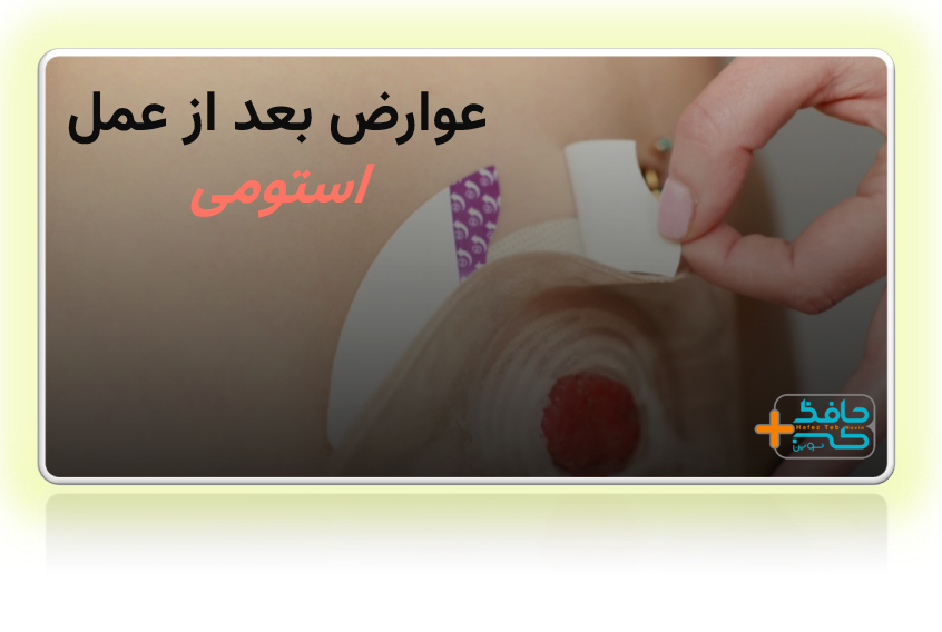 عوارض بعد از عمل استومی