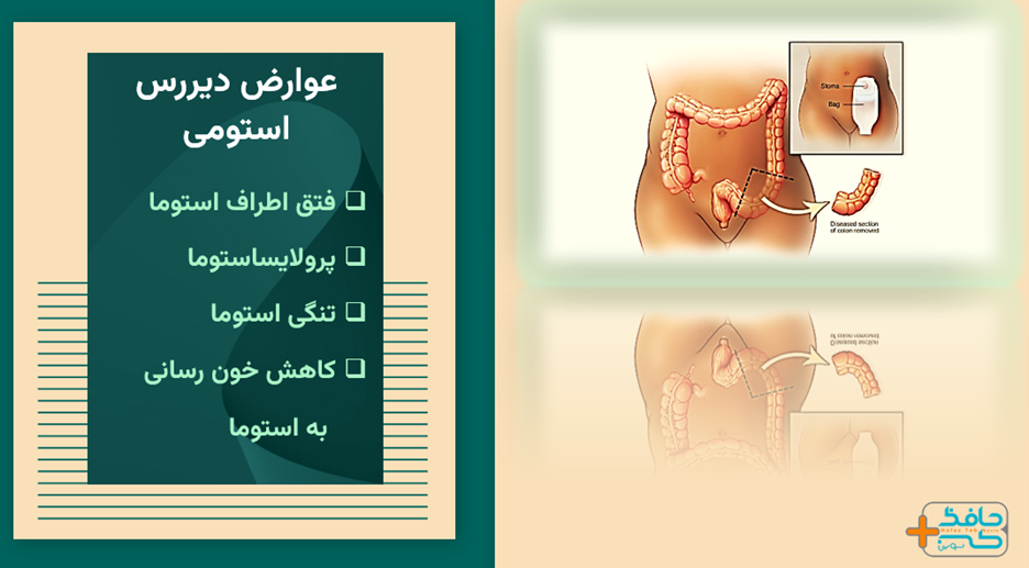 عوارض دیررس استومی ممکن است بعد از چند سال مشاهده شود